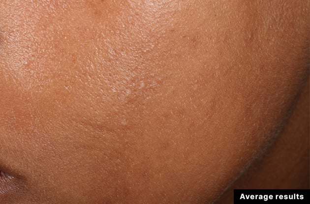 SkinCeuticals Phloretin CF clinical results - after image showing improved skin tone and reduced discoloration