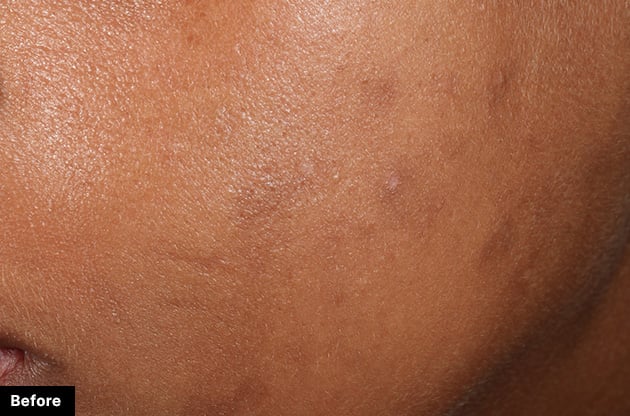 SkinCeuticals Phloretin CF clinical results - before image showing skin discoloration and uneven tone
