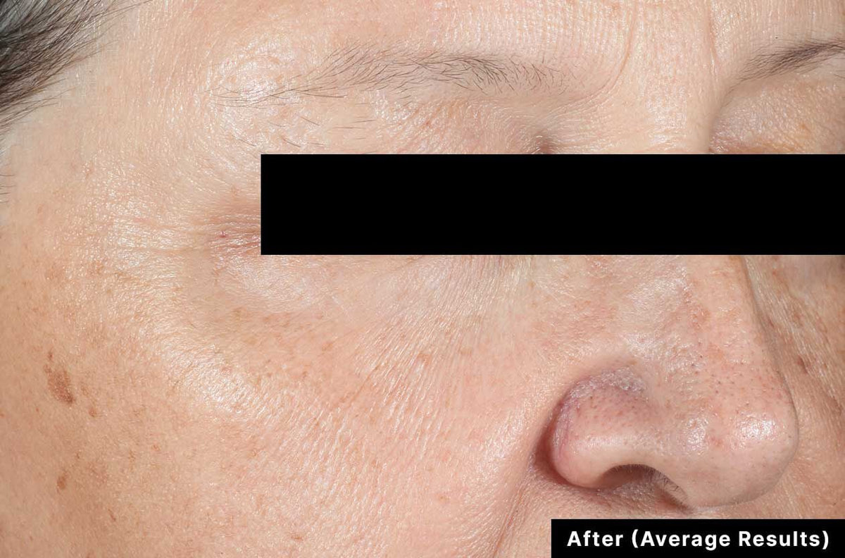 SkinCeuticals A.G.E. Advanced Eye clinical results - after image showing brighter, smoother eye area