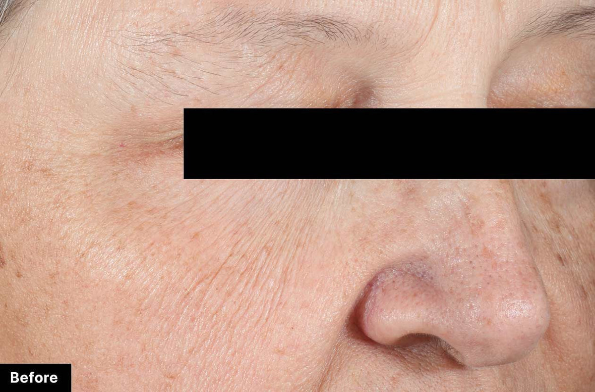 SkinCeuticals A.G.E. Advanced Eye clinical results - before image showing dark circles and crow's feet