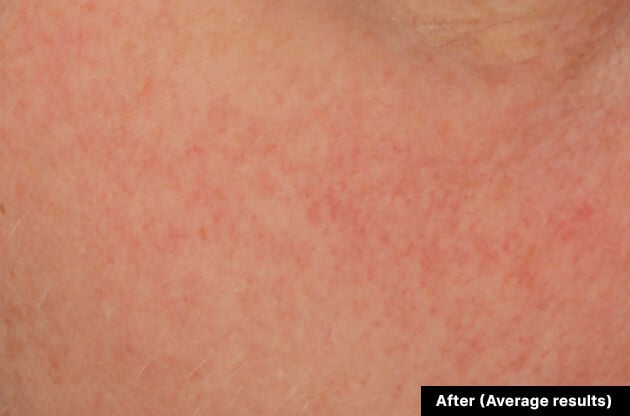 SkinCeuticals Glycolic 10 Renew Overnight clinical results - after image showing smoother, brighter skin
