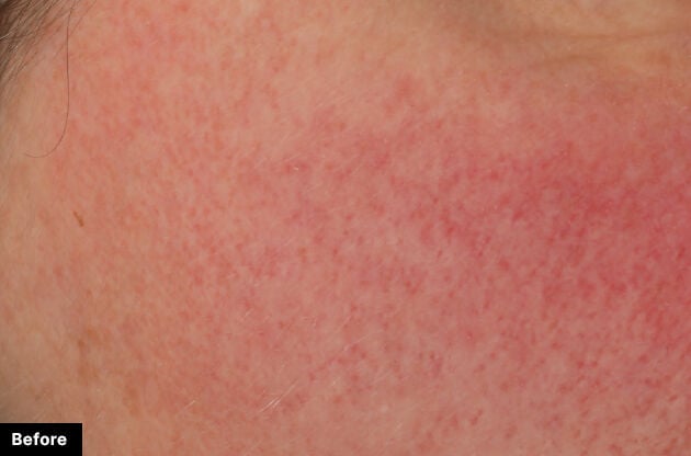 SkinCeuticals Glycolic 10 Renew Overnight clinical results - before image