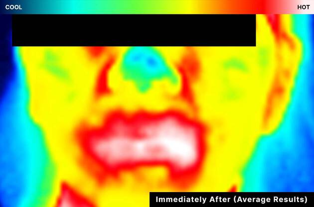 SkinCeuticals Phyto Corrective Gel clinical results - after image showing calmer, more even skin
