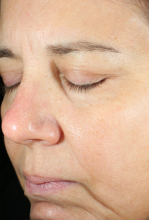 ZO Skin Health Daily Power Defense clinical study results, subject 1 - after week 12