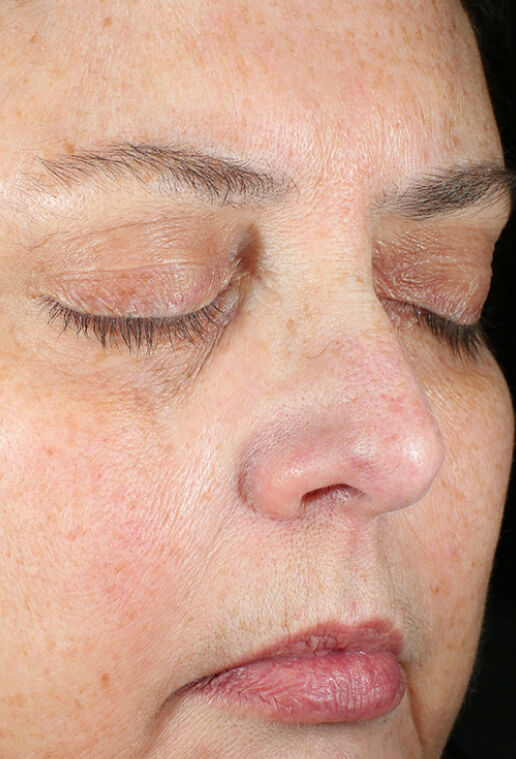 ZO Skin Health Daily Power Defense clinical study results, subject 2 - after week 12