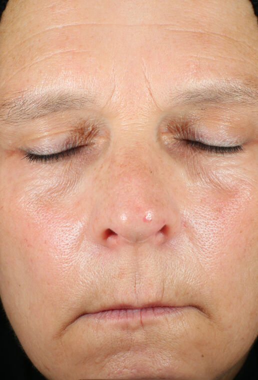 ZO Skin Health Wrinkle + Texture clinical study results, subject 1 - after week 12