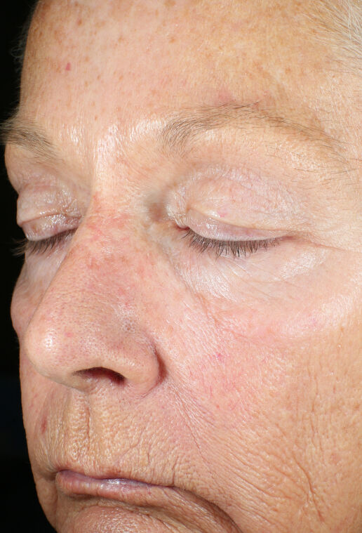 ZO Skin Health Wrinkle + Texture clinical study results, subject 2 - after week 12