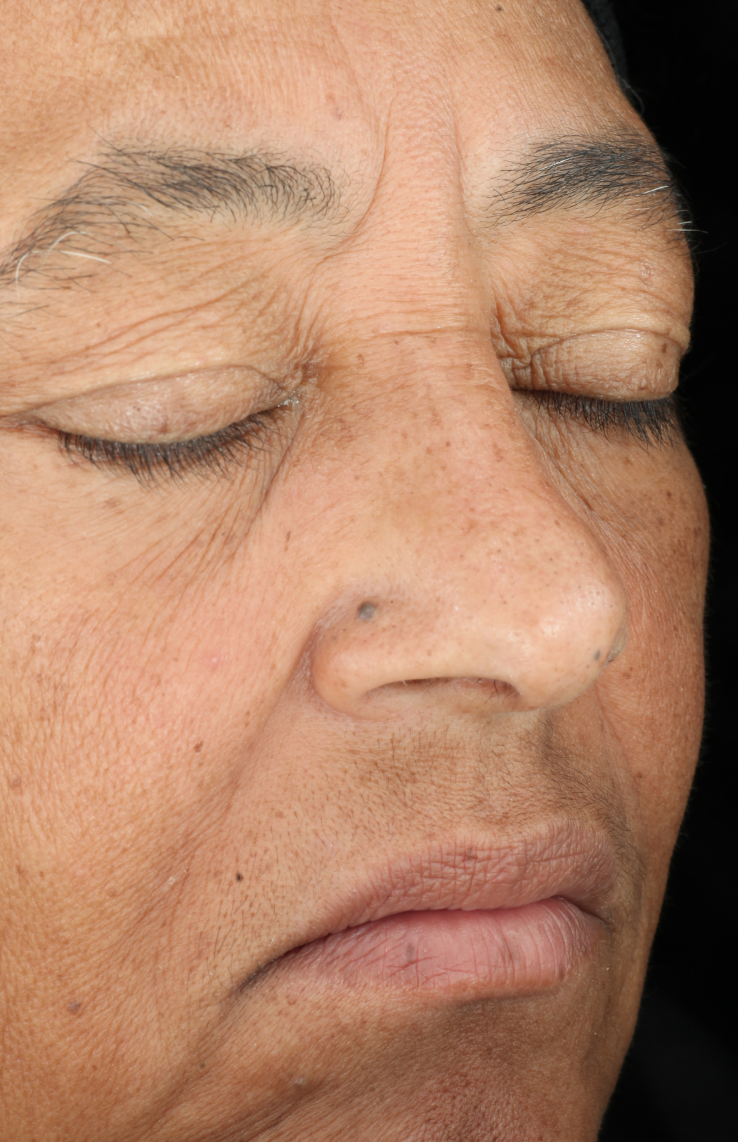ZO Skin Health Growth Factor Serum clinical study results, subject 2 - before