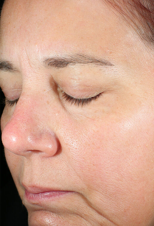 ZO Skin Health Daily Power Defense clinical study results, subject 1 - before