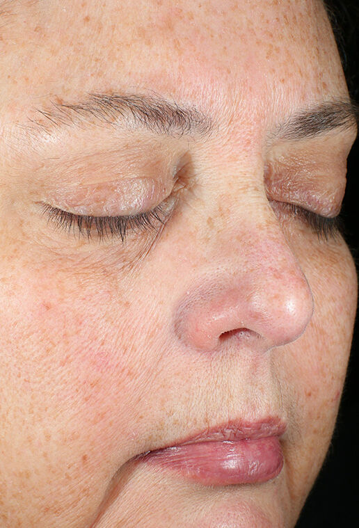 ZO Skin Health Daily Power Defense clinical study results, subject 2 - before