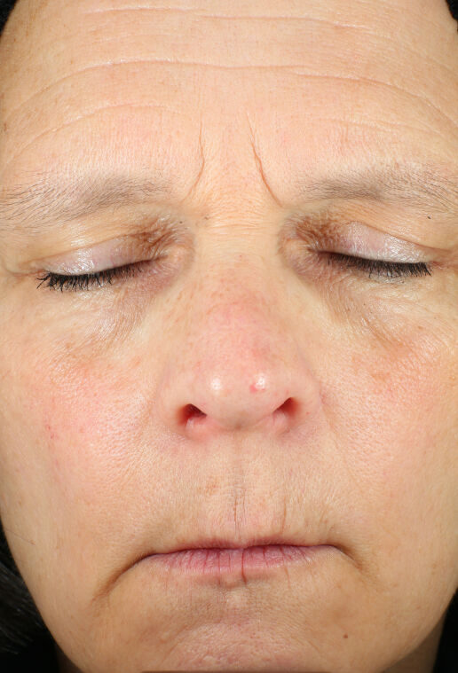 ZO Skin Health Wrinkle + Texture clinical study results, subject 1 - before