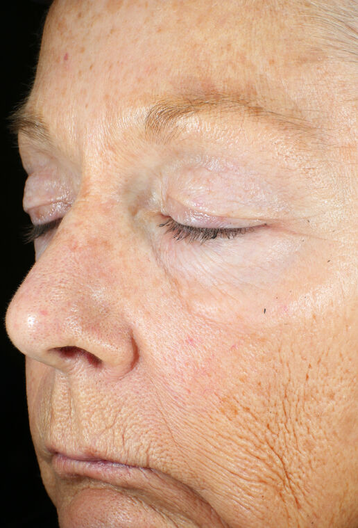 ZO Skin Health Wrinkle + Texture clinical study results, subject 2 - before
