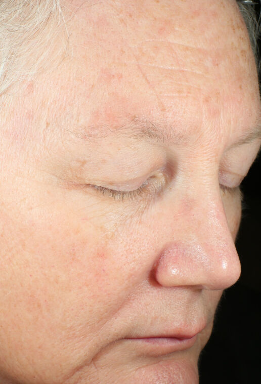 ZO Skin Health Brightalive Skin Brightener clinical study results, participant 2 - after week 15