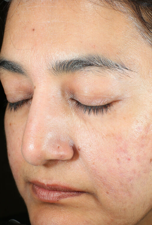 ZO Skin Health Brightalive Skin Brightener clinical study results, participant 3 - after week 15