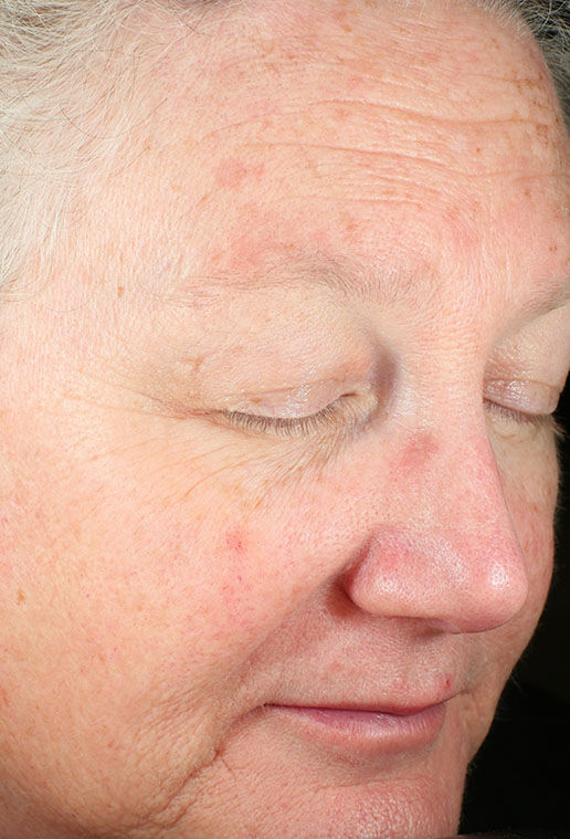 ZO Skin Health Brightalive Skin Brightener clinical study results, participant 2 - before