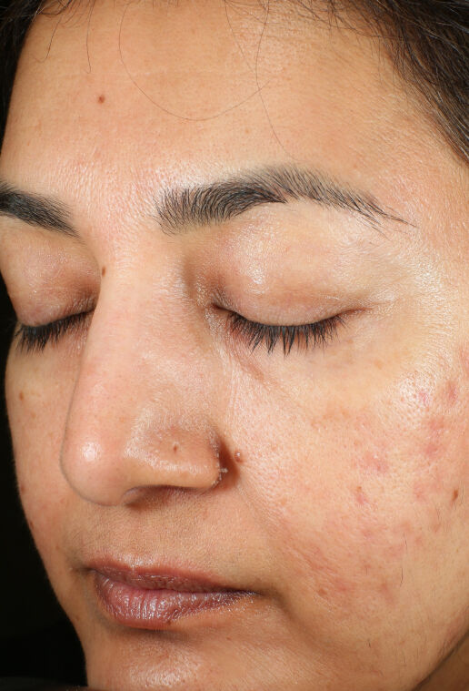ZO Skin Health Brightalive Skin Brightener clinical study results, participant 3 - before