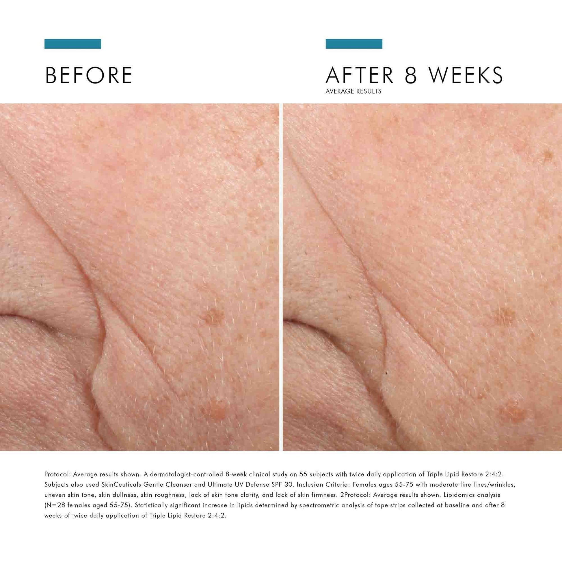 SkinCeuticals Triple Lipid Restore 2:4:2 clinical results - before and after 8 weeks